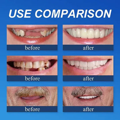 🌎Ends Today: 80% OFF!⏰KLENIMORE™ Custom-Fit Smile Support Kit — Strong Suction Feel & Natural-Looking Fit