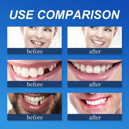 🌎Ends Today: 80% OFF!⏰KLENIMORE™ Custom-Fit Smile Support Kit — Strong Suction Feel & Natural-Looking Fit
